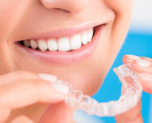 Clear Aligners